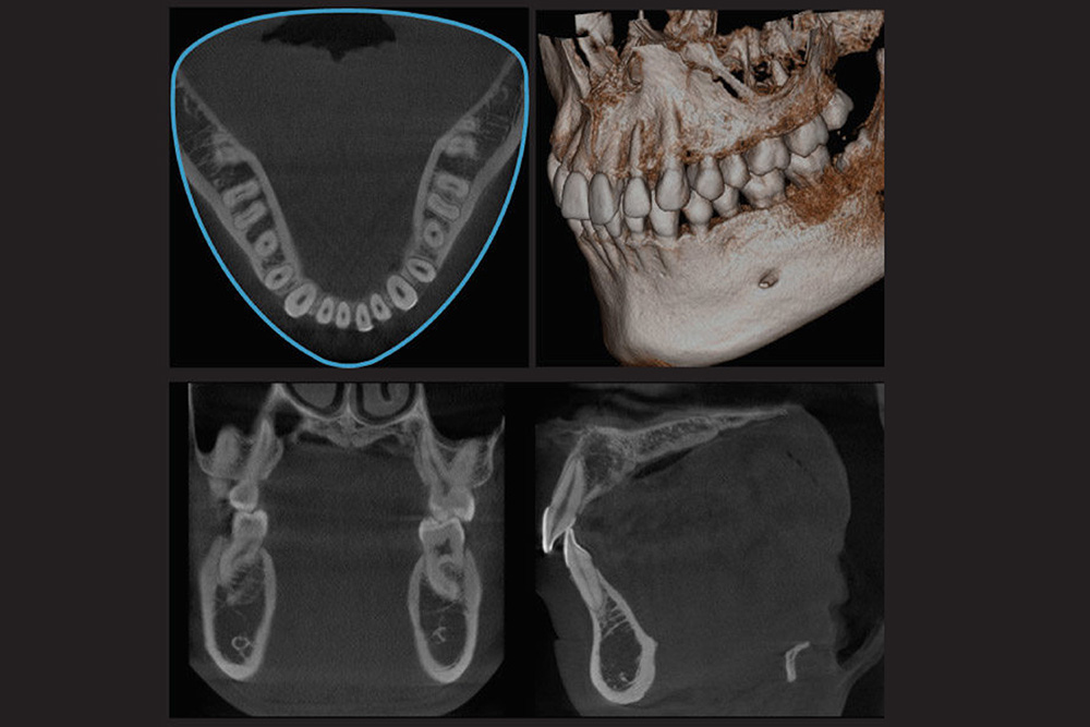 歯科用CT