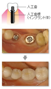 インプラントのメリット1
