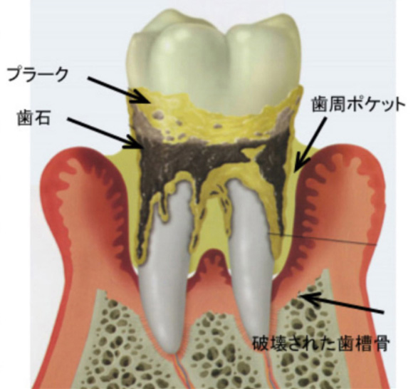 進行した歯周病