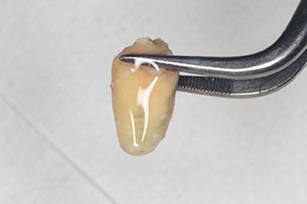 歯の延命を図る処置「意図的再植術（歯の再植）」
