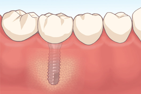 インプラント