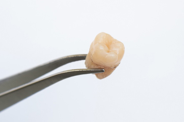 移植(自家歯牙移植)のタイミング・方法は?